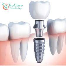  All About Dental Implant Materials: Which is Right for You?
